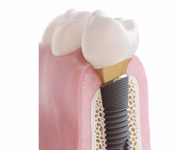 Choosing a Professional for Your Dental Implants in Fresno